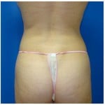 Liposuction Before & After Patient #380