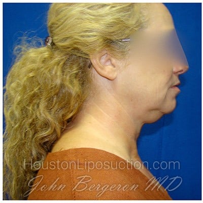 Liposuction Before & After Patient #278