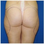 Liposuction Before & After Patient #385