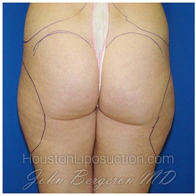 Liposuction Before & After Patient #385