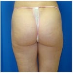 Liposuction Before & After Patient #385