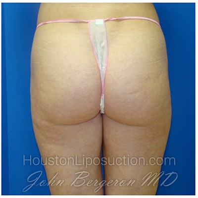 Liposuction Before & After Patient #385
