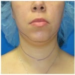 Liposuction Before & After Patient #388