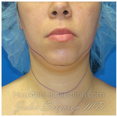 Liposuction Before & After Patient #388