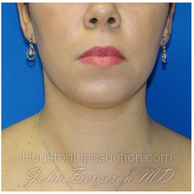 Liposuction Before & After Patient #388