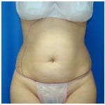 Liposuction Before & After Patient #391