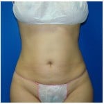 Liposuction Before & After Patient #391