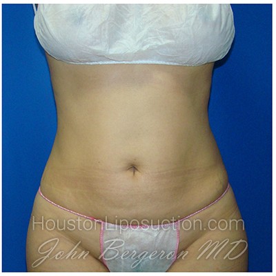 Liposuction Before & After Patient #391