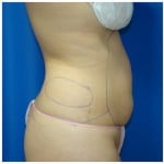 Liposuction Before & After Patient #391