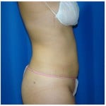 Liposuction Before & After Patient #391