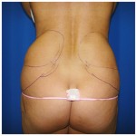 Liposuction Before & After Patient #396