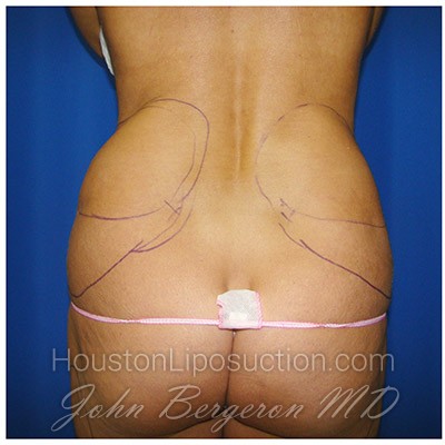 Liposuction Before & After Patient #396