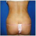 Liposuction Before & After Patient #396