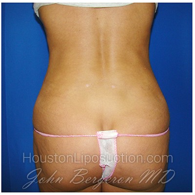 Liposuction Before & After Patient #396