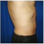 Liposuction Before & After Patient #399