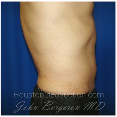 Liposuction Before & After Patient #399