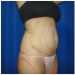 Liposuction Before & After Patient #403