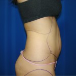 Liposuction Before & After Patient #403
