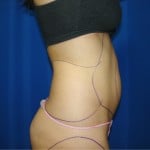 Liposuction Before & After Patient #403