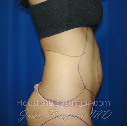 Liposuction Before & After Patient #403