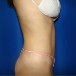 Liposuction Before & After Patient #403