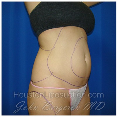 Liposuction Before & After Patient #403