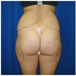 Liposuction Before & After Patient #403