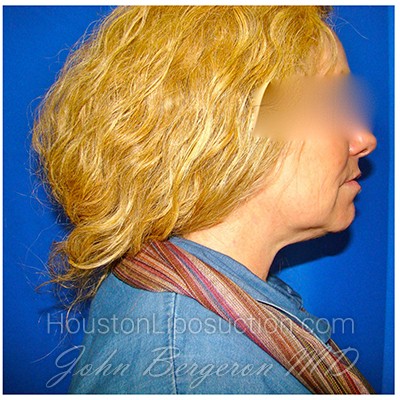 Liposuction Before & After Patient #278