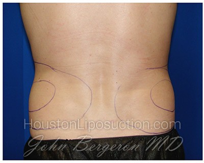 Liposuction Before & After Patient #281