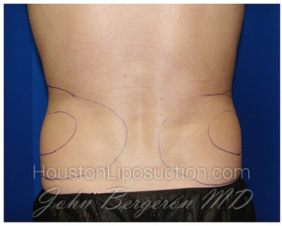 Liposuction Before & After Patient #281