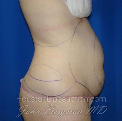 Liposuction Before & After Patient #408