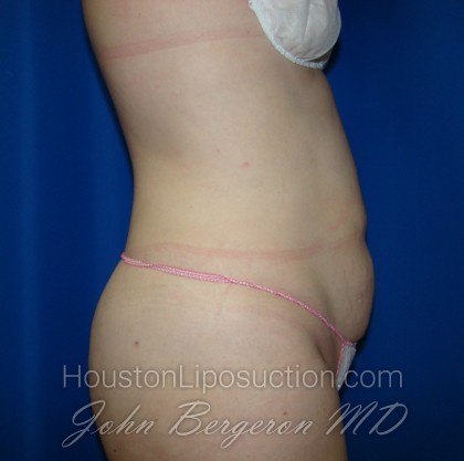 Liposuction Before & After Patient #408