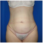 Liposuction Before & After Patient #408