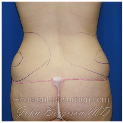 Liposuction Before & After Patient #408