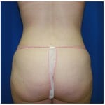 Liposuction Before & After Patient #408