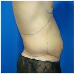 Liposuction Before & After Patient #413