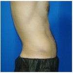 Liposuction Before & After Patient #413