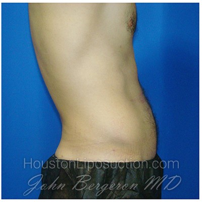 Liposuction Before & After Patient #413