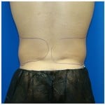 Liposuction Before & After Patient #413