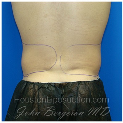 Liposuction Before & After Patient #413