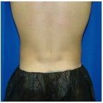 Liposuction Before & After Patient #413