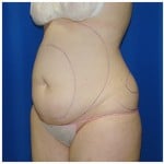 Liposuction Before & After Patient #408