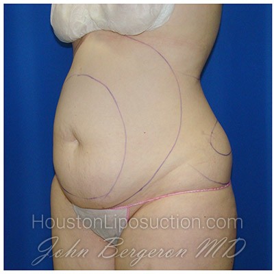 Liposuction Before & After Patient #408