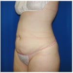 Liposuction Before & After Patient #408