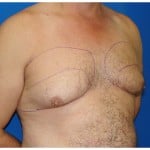 Liposuction Before & After Patient #424