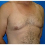 Liposuction Before & After Patient #424