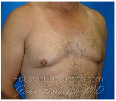 Liposuction Before & After Patient #424