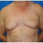 Liposuction Before & After Patient #424