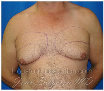Liposuction Before & After Patient #424