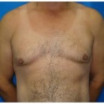 Liposuction Before & After Patient #424